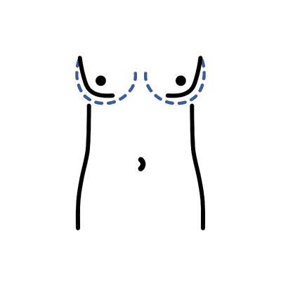 MTF Breast Augmentation