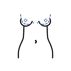 Periareolar Top Surgery